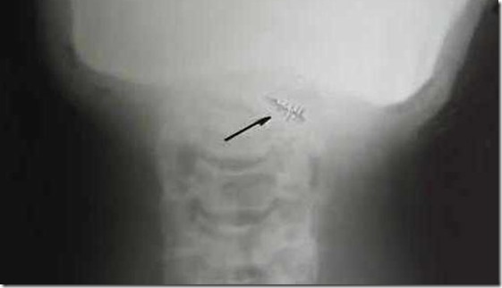 implantes-alienigenas